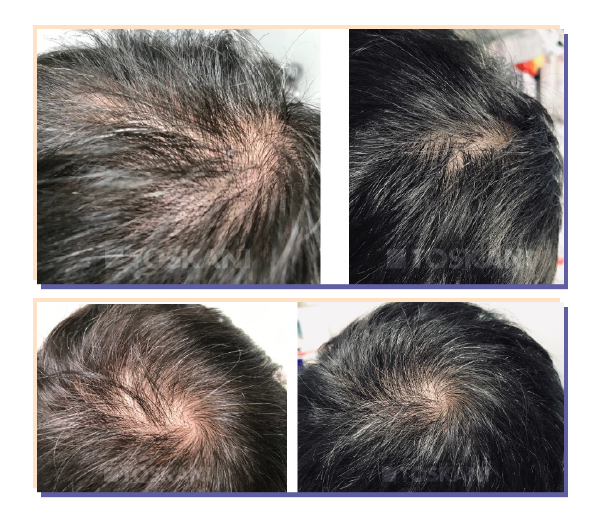 Antes e Depois - Mesojectgun